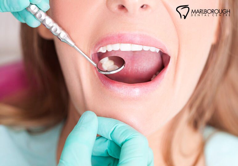 MDC - Blog - 5 Types Of Dental Fillings